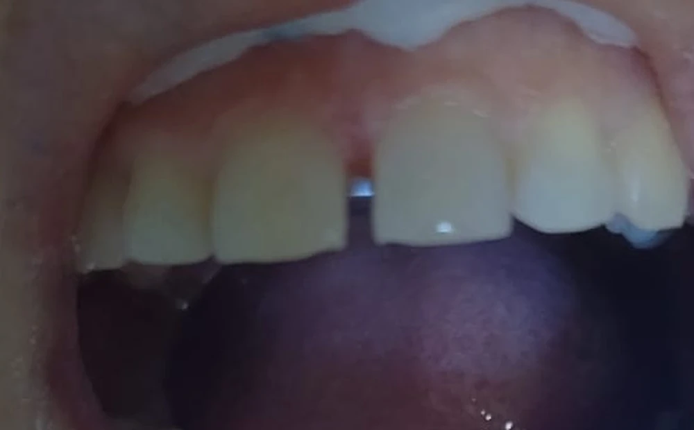 Antes do tratamento: espaço aberto entre os dentes da frente