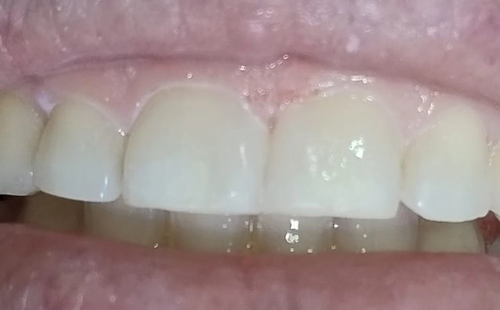 Depois do tratamento: espaço fechado, dentes da frente unidos